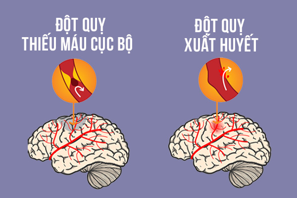 Hai loại đột quỵ